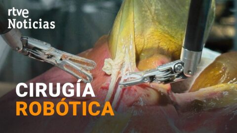 Hospital de Bellvitge realiza trasplante renal robótico con una sola incisión